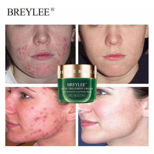 BREYLEE Acne Treatment Cream