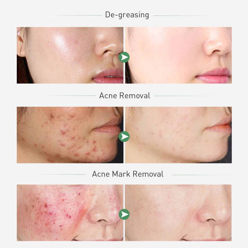 Acne Pore Skin Care Kit