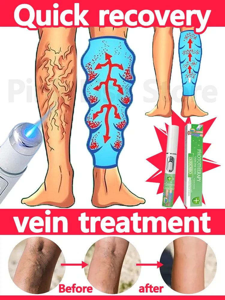 Vein problems.