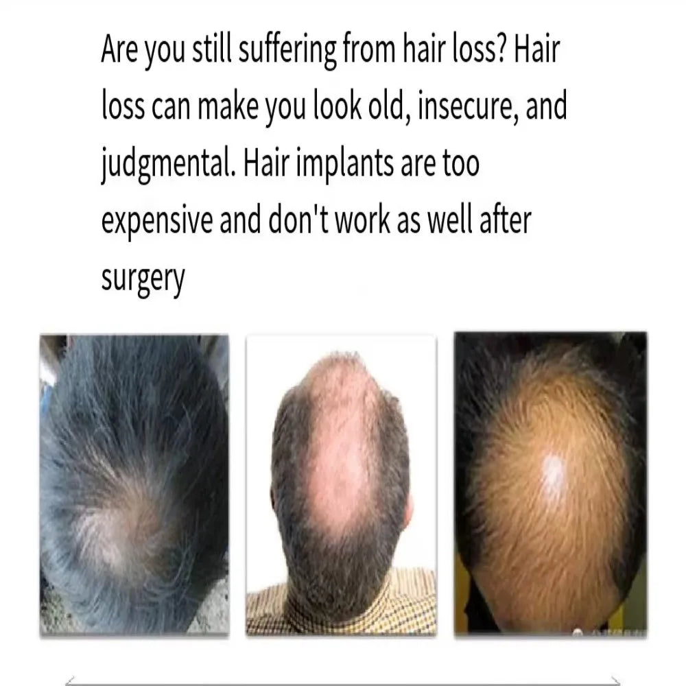 Wig patch for Men